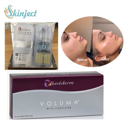Juvederm Voluma Dermal Filler Hyaluronic Acid For Facial Cheek Chin Contour