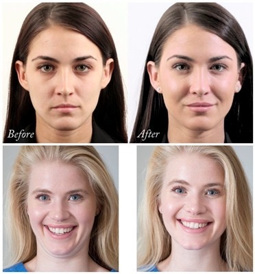 Upgrade Juvederm Voluma Hyaluronic Acid Facial Filler 24 Mg/Ml