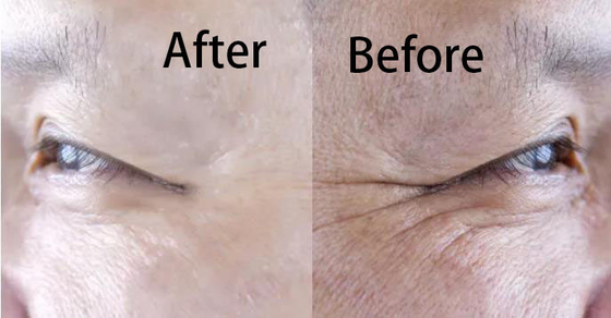 Hyaluronic Acid Filler Collagen Regeneration Whitening And Anti Aging Injection