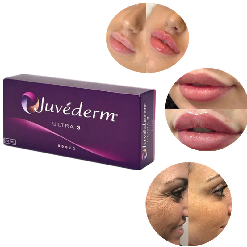 Safe Crosslinked Dermal Hyaluronic Acid Filler For All Skin Types