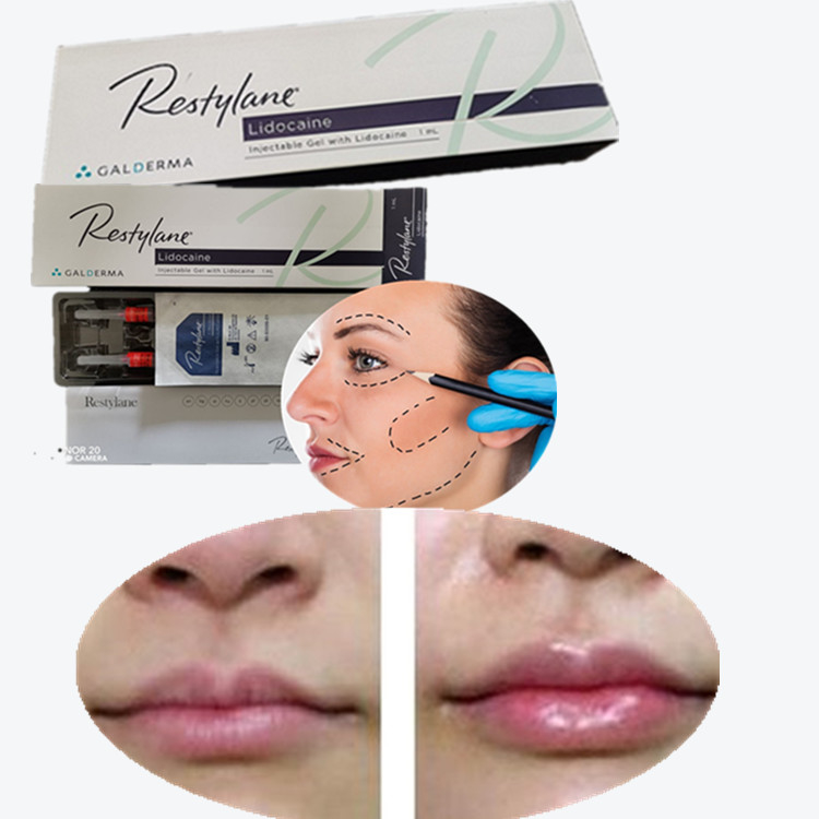 Dermal Filler Lip Injections Korean Original Authentic Products Lip Sodium Hyaluronate Filler