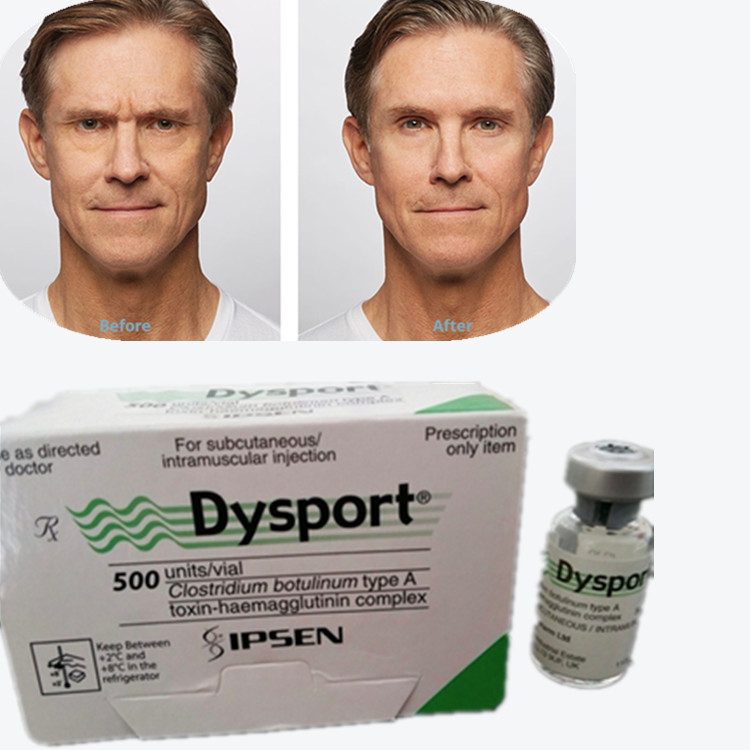 Botulinum Toxin Dysport 100IU Botulinum Toxin Type A for Wrinkle Removal