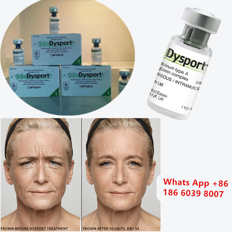 Dysport 500u Botulinum Toxin Type A for Cheek Enhancement