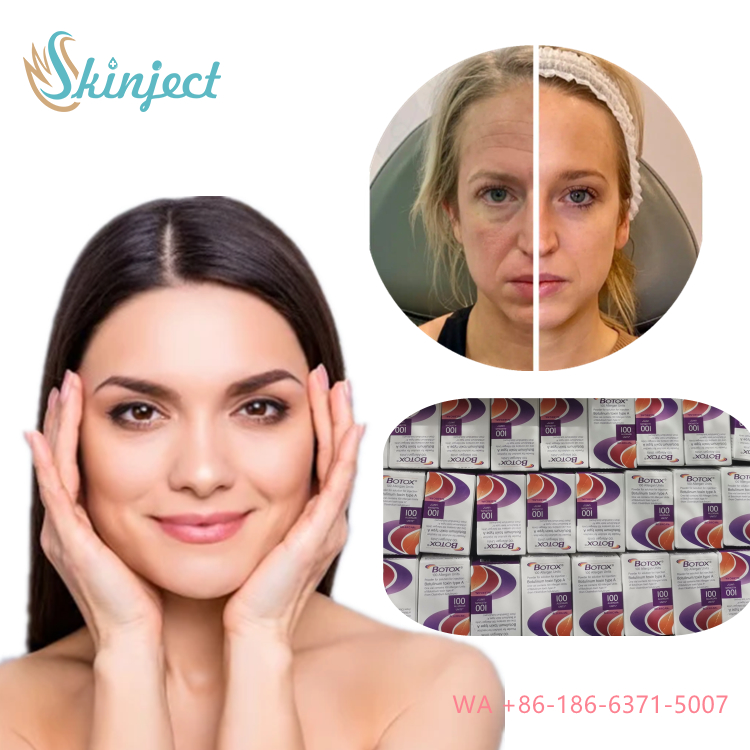 Allergan  Nobota 100u 200u for Effective Treatment of Frown Lines Botulinum Toxin Injections