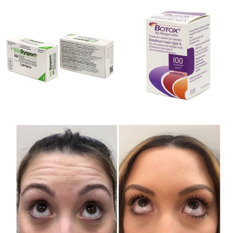 100 Units Korea BTX Botulinum Toxin for Wrinkles and Fine Lines