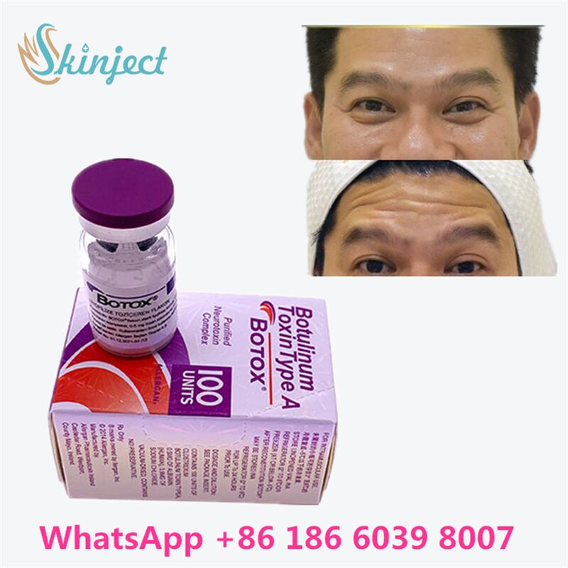 Botulinum Toxin ALLERGAN Duration 4 to 6 Months 100 Units Type A