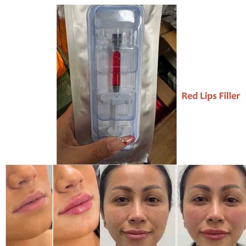 Red Lip Fullness Dermal Filler Injection For Salons Clinics And Aethetics