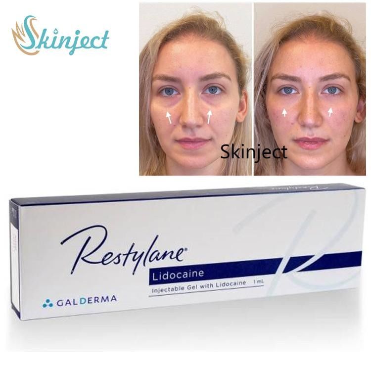 1 ml Hyaluronic Acid Dermal Filler For Nasolabial Folds Dark circles