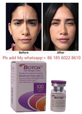 ALLERGAN  Injection Botulinum Toxin Type A
