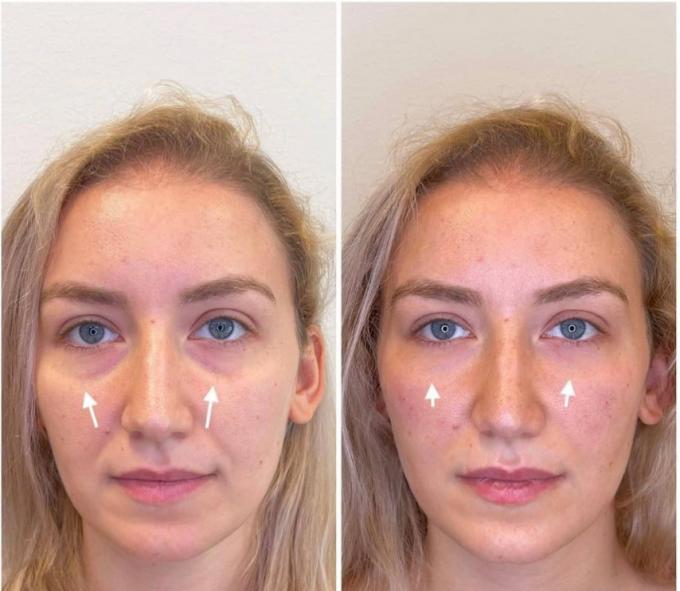 1 ml Hyaluronic Acid Dermal Filler For Nasolabial Folds Dark circles